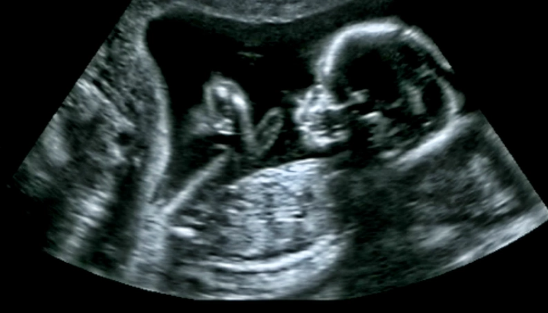 Chute Do Bebe Dentro Da Barriga Da Mamae Pode Chegar A 5kg De Forca Diz Estudo 98fm Curitiba Sintonize 98 9